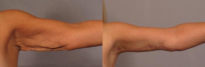 Arm Lift Before and 6 Months After, Left Inner Straight