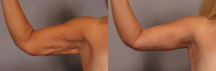 Arm Lift Before and 6 Months After, Right Inner Bent