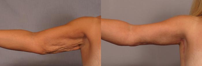 Arm Lift Before and 6 Months After, Right Inner Straight