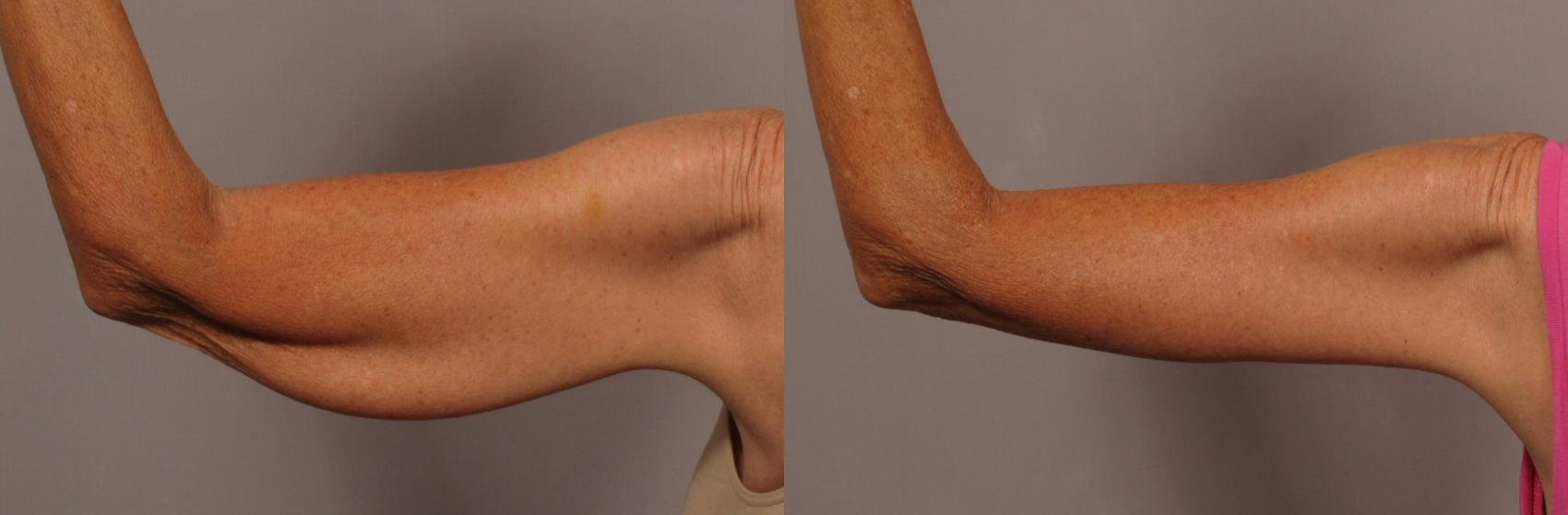 Body Contouring: What Is An Arm Lift?