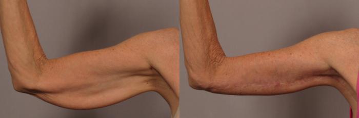 Inside View of Right Upper Arm Before Arm Lift (Brachioplasty)