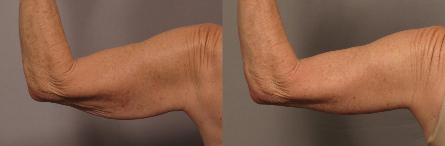 Posterior View of Left Upper Arm Before Arm Lift (Brachioplasty)