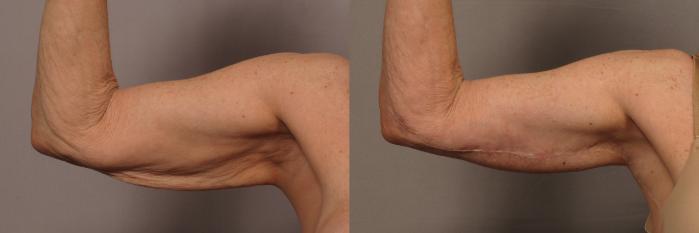 Inside View of Right Upper Arm Before Arm Lift (Brachioplasty)
