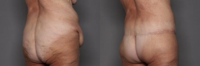 Before Body Lift after MWL, Back view