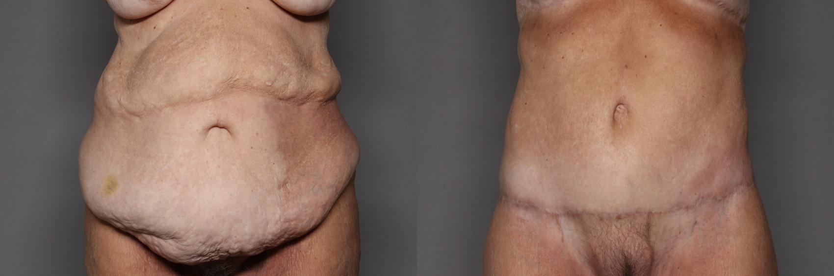 Before Body Lift after MWL, front view