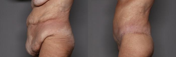 Before Body Lift after MWL, Left Side view