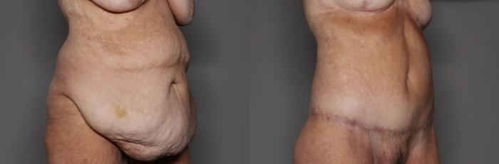Before Body Lift after MWL, R Oblique view