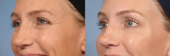 Before & After BOTOX® Cosmetic Case 20 View #1 View in Naples and Ft. Myers, FL
