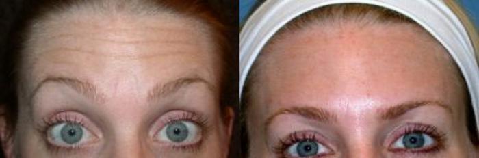 Before & After BOTOX® Cosmetic Case 20 View #2 View in Naples and Ft. Myers, FL