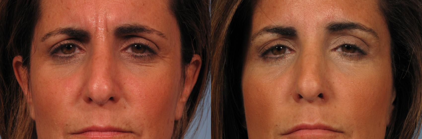 Before & After BOTOX® Cosmetic Case 248 View #1 View in Naples and Ft. Myers, FL