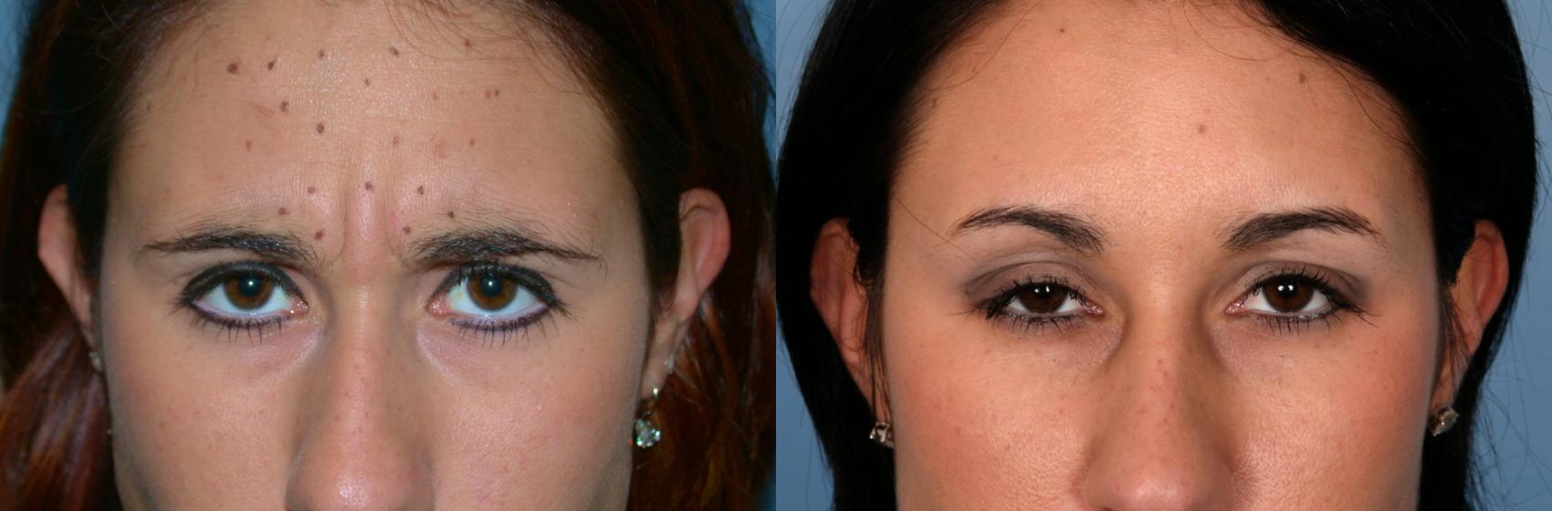 Before & After BOTOX® Cosmetic Case 57 View #1 View in Naples, FL