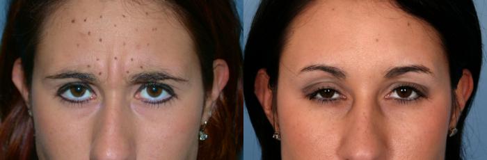Before & After BOTOX® Cosmetic Case 57 View #1 View in Naples and Ft. Myers, FL