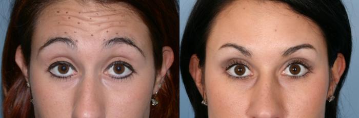 Before & After BOTOX® Cosmetic Case 57 View #2 View in Naples and Ft. Myers, FL