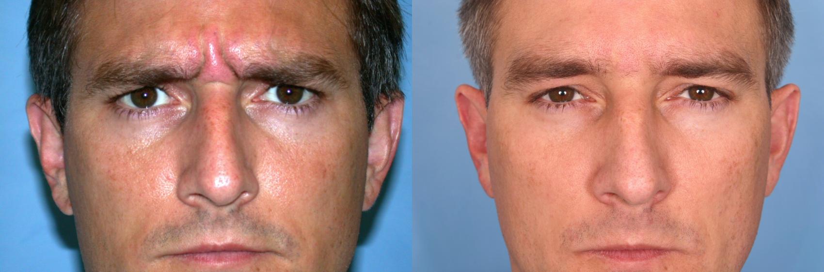 Before & After BOTOX® Cosmetic Case 58 View #1 View in Naples, FL