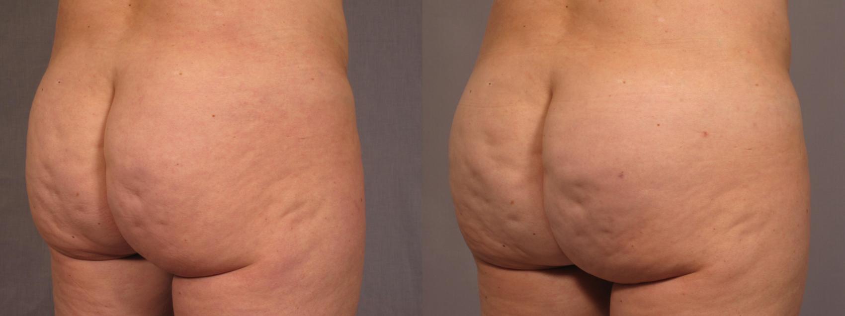 Before & After Brazilian Butt Lift Case 293 View #1 View in Naples and Ft. Myers, FL