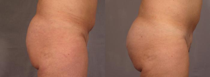 Before & After Brazilian Butt Lift Case 293 View #2 View in Naples and Ft. Myers, FL