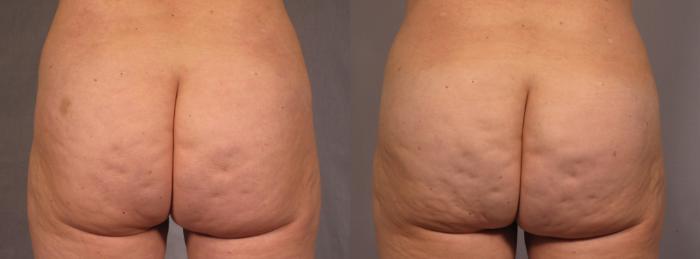 Before & After Brazilian Butt Lift Case 293 View #4 View in Naples and Ft. Myers, FL