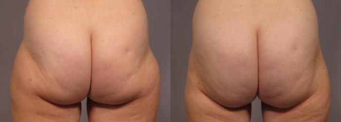 Before & After Brazilian Butt Lift Case 312 View #1 View in Naples and Ft. Myers, FL