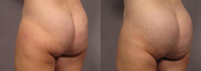 Before & After Brazilian Butt Lift Case 312 View #2 View in Naples and Ft. Myers, FL