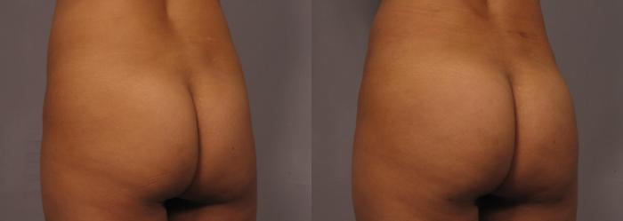 Before & After Brazilian Butt Lift Case 319 View #2 View in Naples and Ft. Myers, FL
