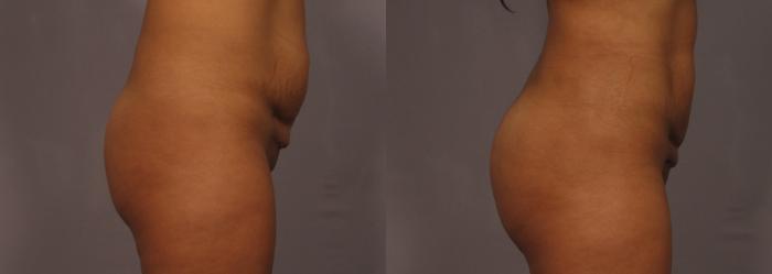Before & After Brazilian Butt Lift Case 319 View #3 View in Naples and Ft. Myers, FL