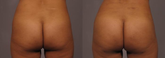 Before & After Brazilian Butt Lift Case 319 View #4 View in Naples and Ft. Myers, FL