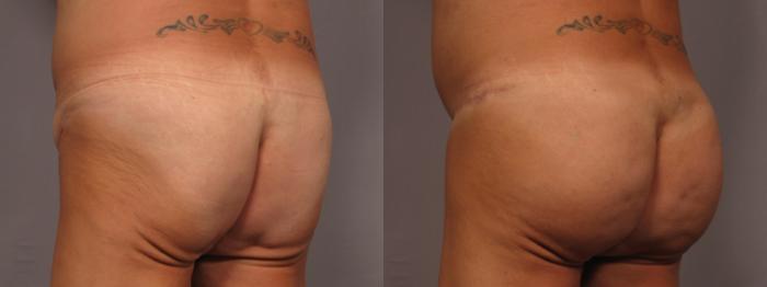 Before & After Brazilian Butt Lift Case 328 View #2 View in Naples and Ft. Myers, FL