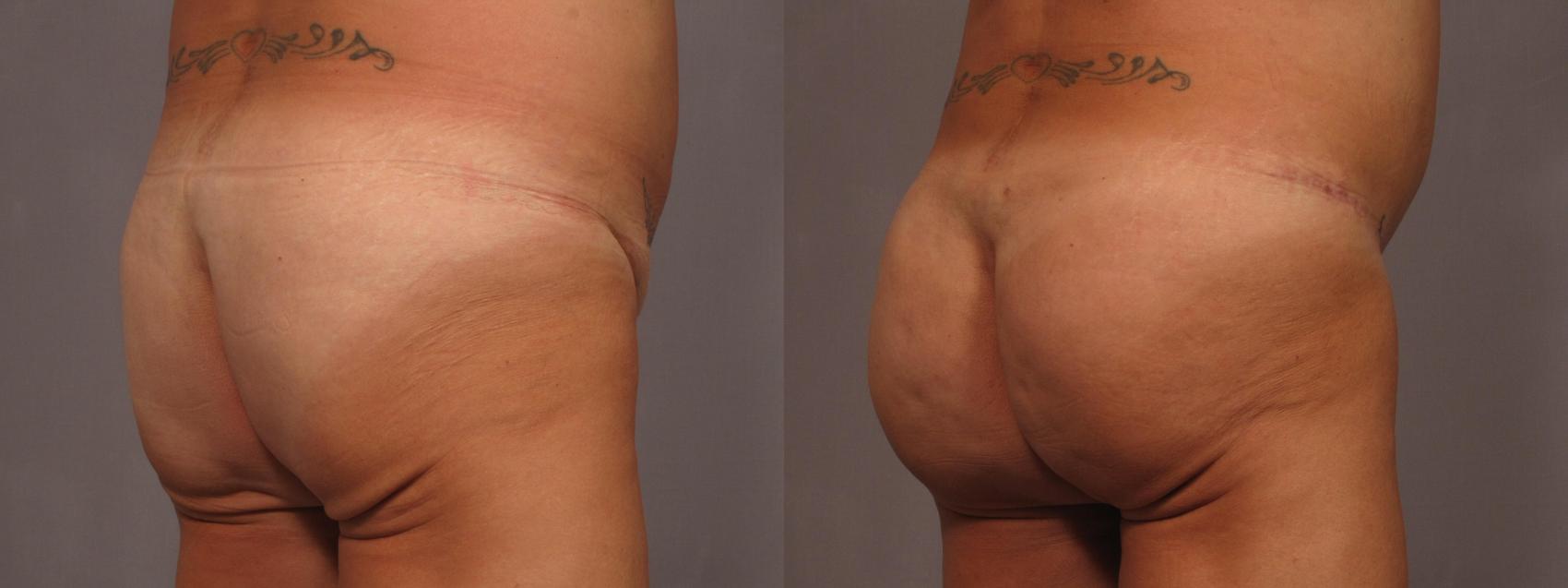 Brazilian Before and After Pictures 328 | Naples and Ft. Myers, FL | Kent V. Hasen, MD: Aesthetic Plastic Surgery & Med Spa of