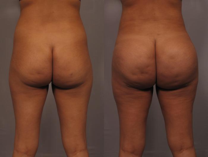 Brazilian Butt Lift (BBL) Before and 1 Year After, Posterior