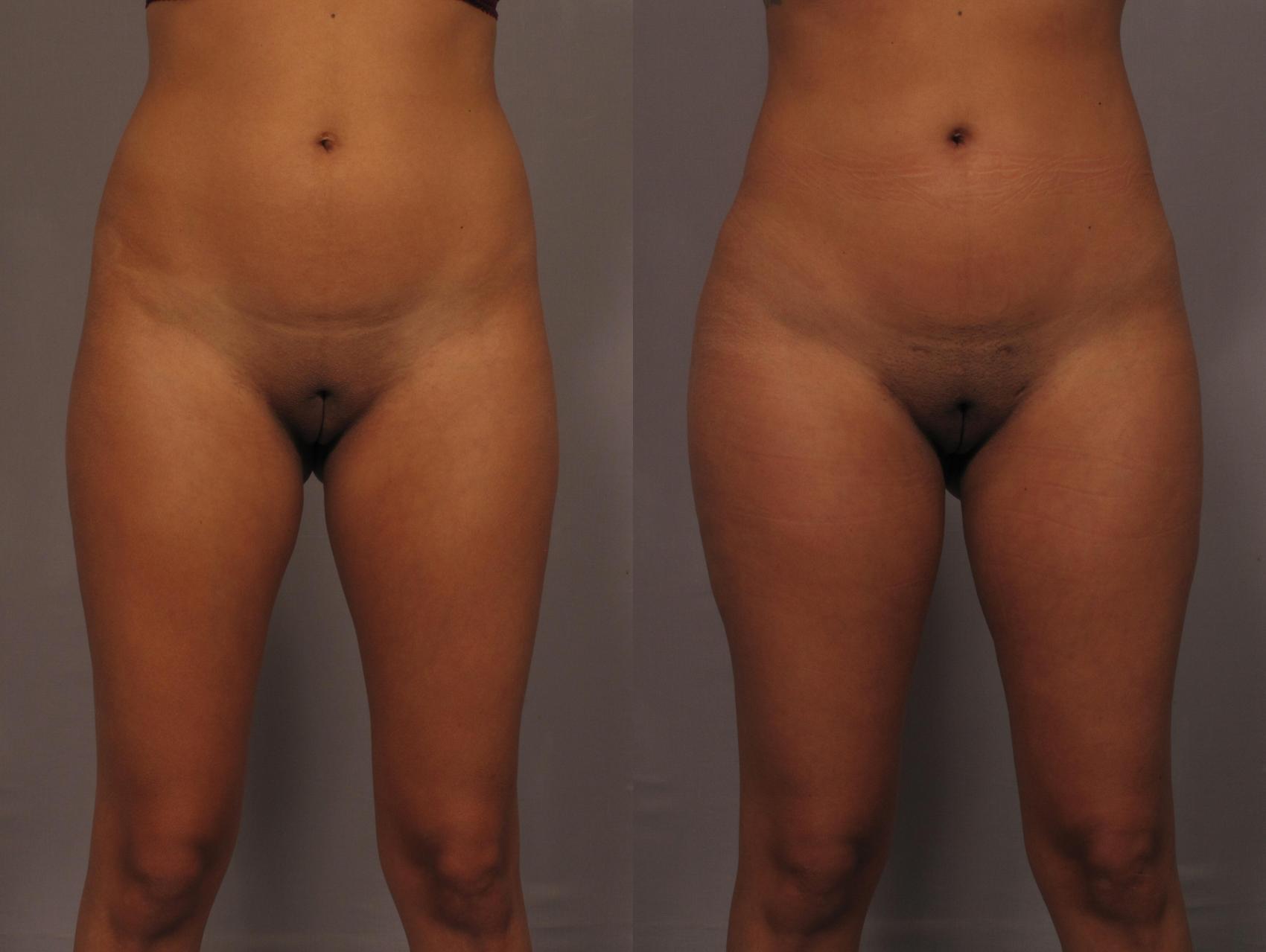 Brazilian Butt Lift (BBL) Before and 1 Year After, Front