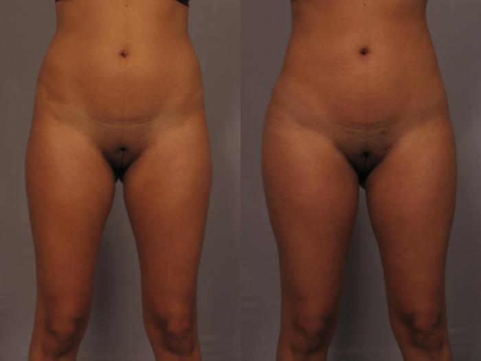 Brazilian Butt Lift (BBL) Before and 1 Year After, Front