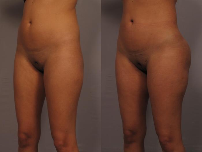 Brazilian Butt Lift (BBL), Before and 1 Year After, Left Oblique