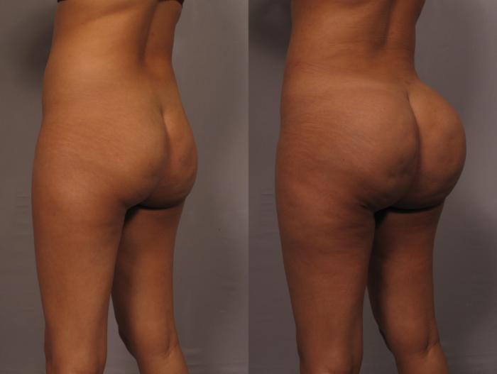 Brazilian Butt Lift (BBL), Before and 1 Year After, Left Posterior Oblique