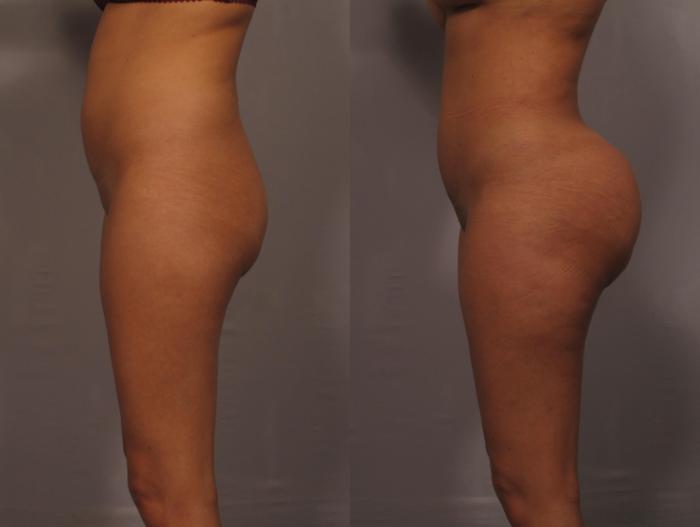 Brazilian Butt Lift (BBL), Before and 1 Year After, Left Side