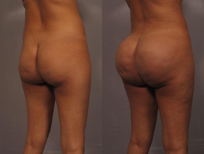 Brazilian Butt Lift (BBL) Before and 1 Year After, Right Posterior Oblique