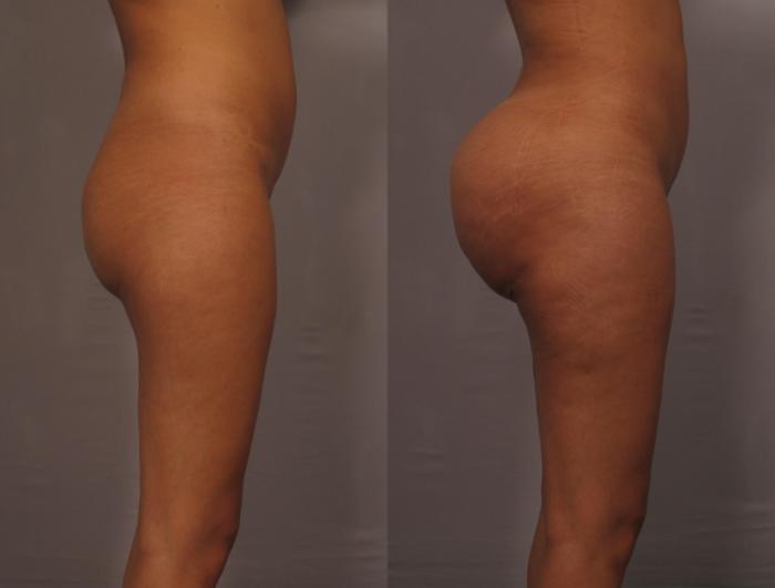 Brazilian Butt Lift (BBL) Before and 1 Year After, Right Side