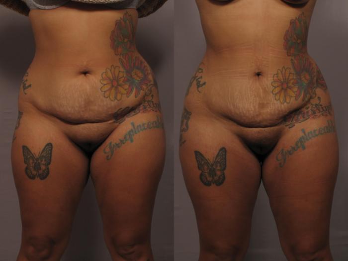 Front view of BBL and liposuction of the tummy, pre op