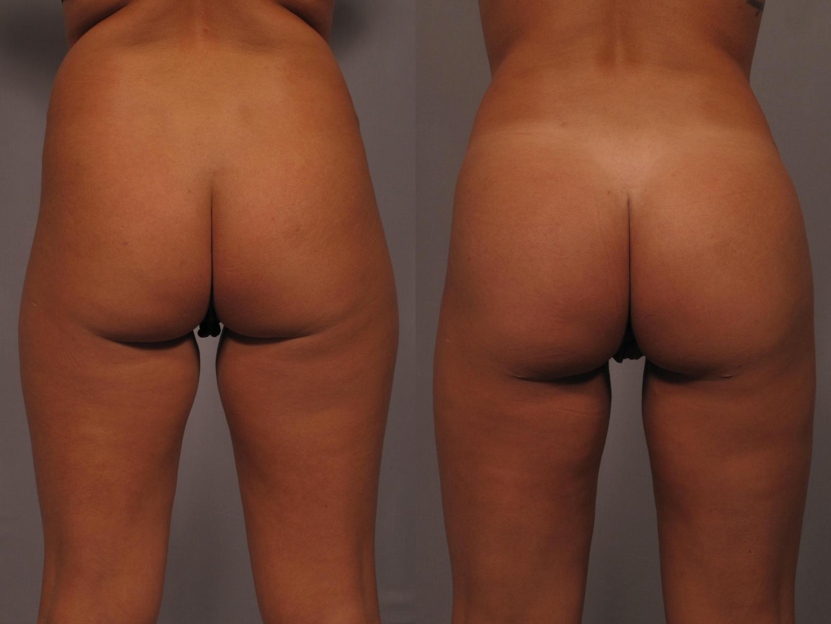 Posterior View of Brazilian Butt Lift in Naples, Florida, pre