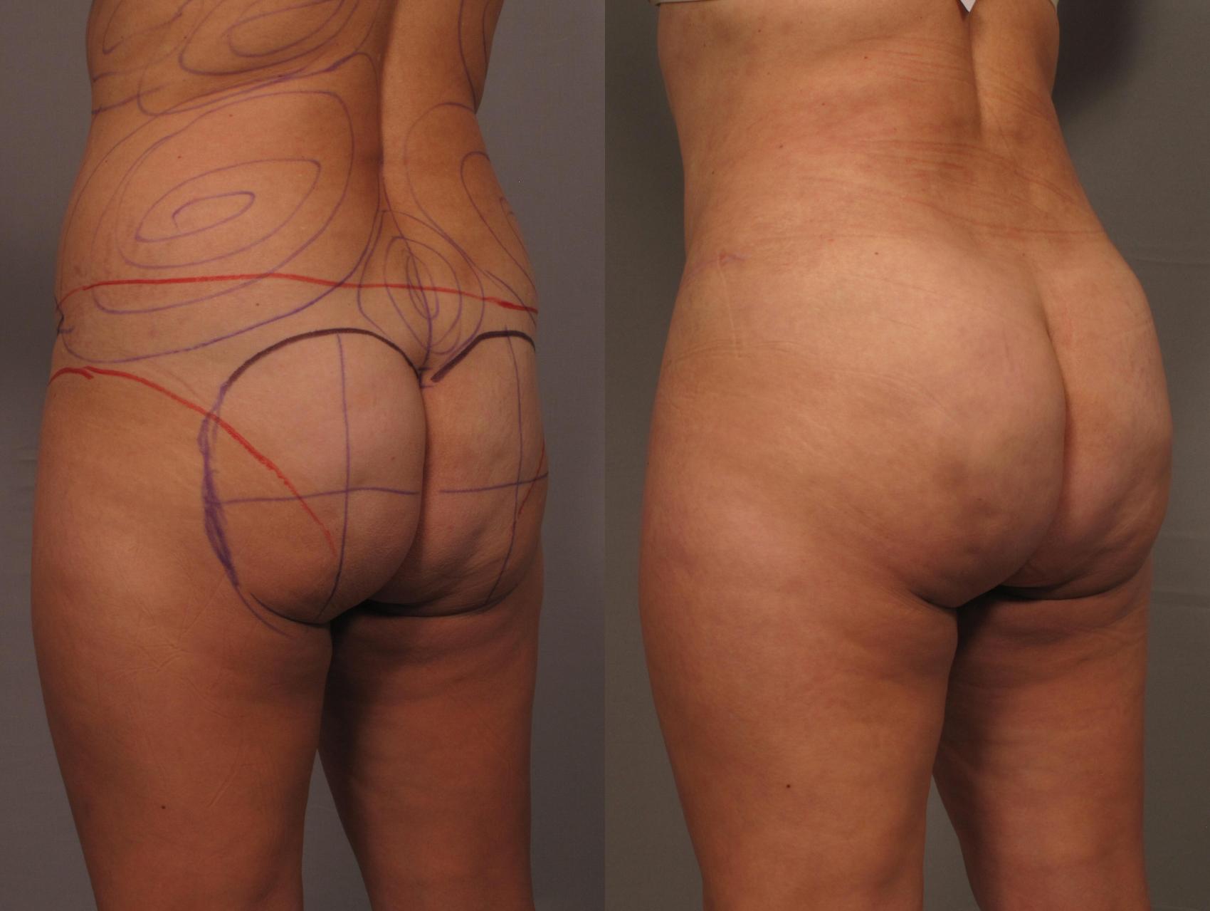 Left Oblique pre-op photo of Brazilian Butt Lift