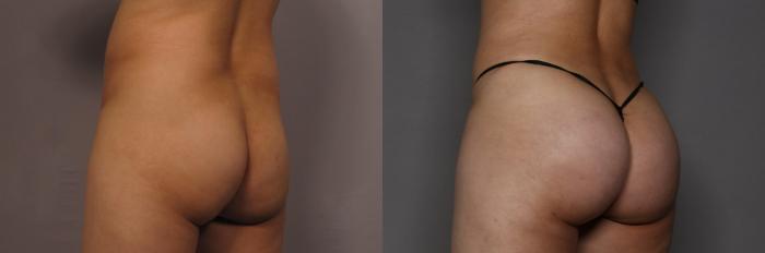 Left Oblique View of BBL, Brazilian Butt Lift and Tummy Tuck, Pre-op