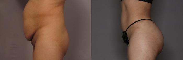 Left Side View of BBL, Brazilian Butt Lift and Tummy Tuck, Pre-op