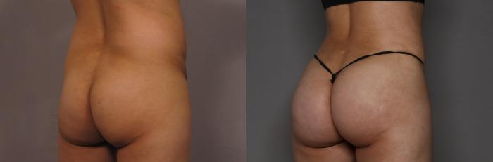 Right Oblique View of BBL, Brazilian Butt Lift and Tummy Tuck, Pre-op