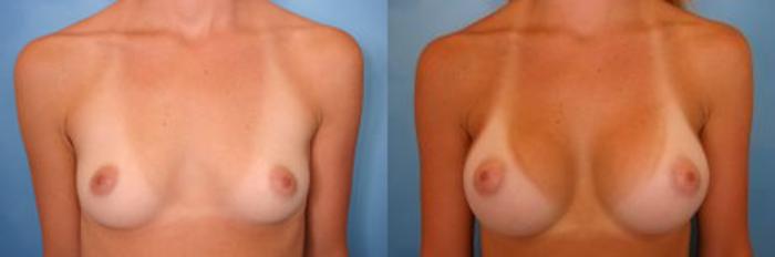 Before & After Breast Augmentation Case 1 View #1 View in Naples and Ft. Myers, FL