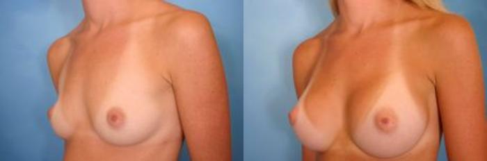 Before & After Breast Augmentation Case 1 View #2 View in Naples and Ft. Myers, FL