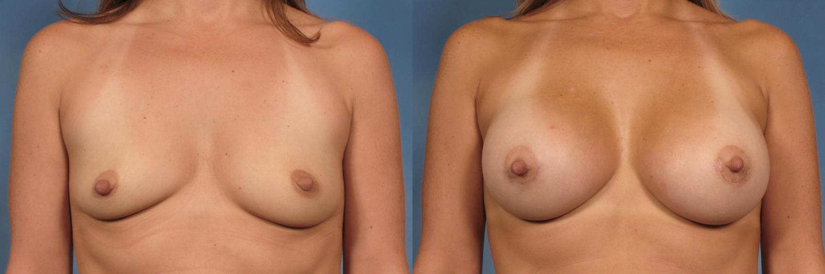 Before & After Breast Augmentation Case 117 View #1 View in Naples and Ft. Myers, FL