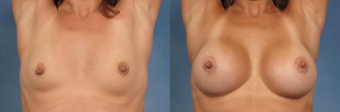 Before & After Breast Augmentation Case 117 View #2 View in Naples and Ft. Myers, FL