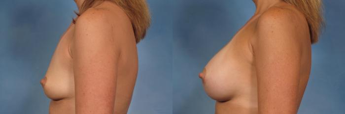 Before & After Breast Augmentation Case 117 View #3 View in Naples and Ft. Myers, FL