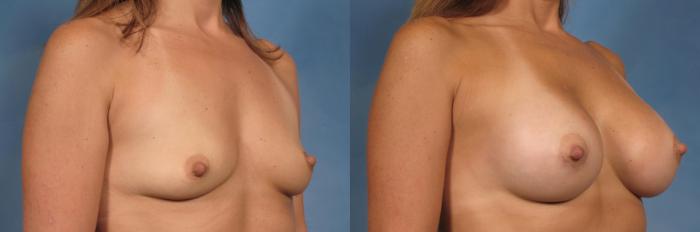 Before & After Breast Augmentation Case 117 View #4 View in Naples and Ft. Myers, FL