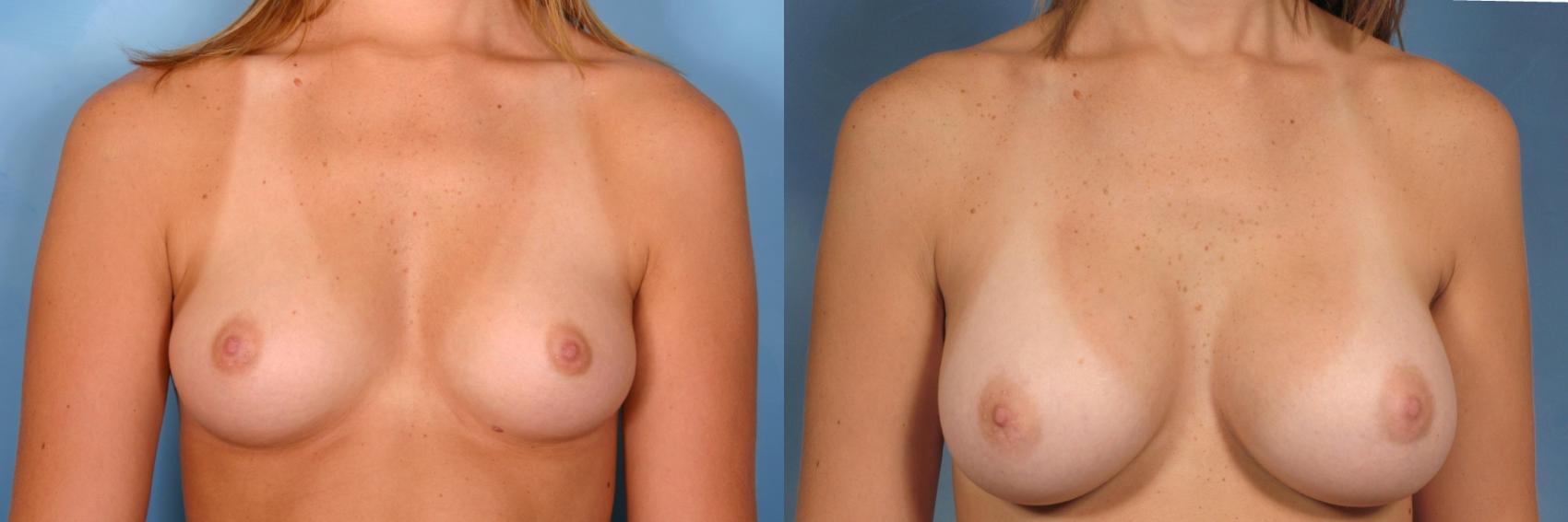 Before & After Breast Augmentation Case 119 View #1 View in Naples and Ft. Myers, FL