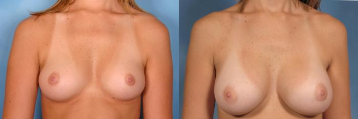 Before & After Breast Augmentation Case 119 View #1 View in Naples and Ft. Myers, FL
